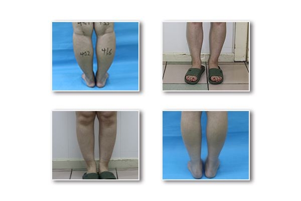 吸脂瘦大腿效果明显吗 大腿吸脂减肥术部位有哪些