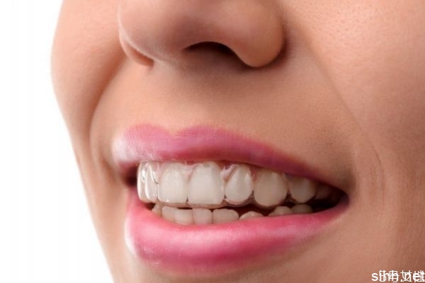 冷光美白牙齿能维持多久呢 冷光美白牙齿多久做一次呢
